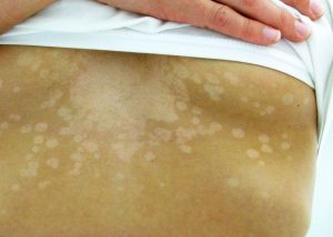 tinea versicolor treatment