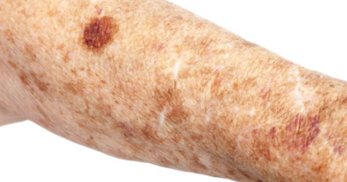 age spots home remedy