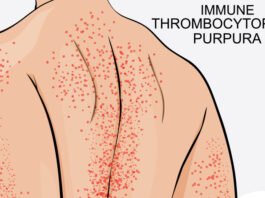 immune thrombocytopenia (ITP)