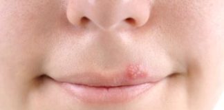 cold sores home remedy