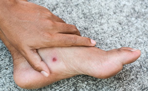 How to make a wound heal faster through home remedies? Natural cures for wounds, wounds home remedy