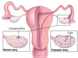 Natural cures for polycystic ovary syndrome