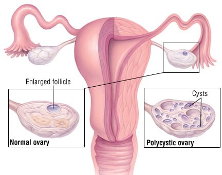 Natural cures for polycystic ovary syndrome