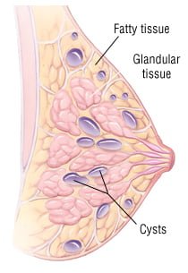 Natural cures for breast cysts, Breast cysts home remedy