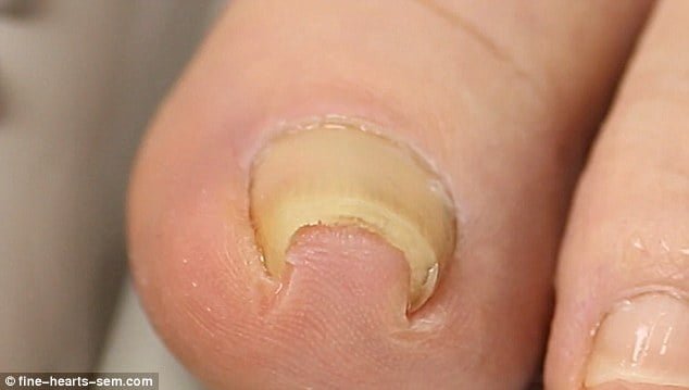 ingrown toenails / fingernails