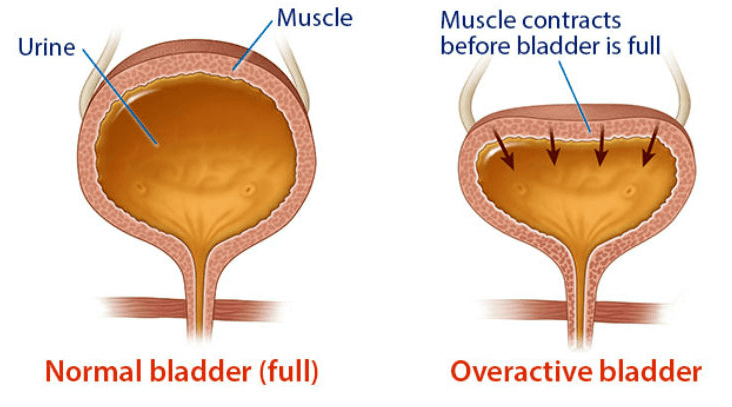 Overactive bladder
