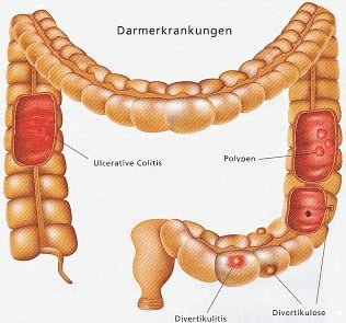 bowel problems