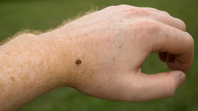 Tick bites – causes, symptoms and other associated risk factors Tick bites