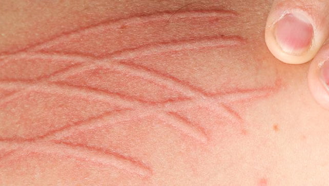 dermatographic urticaria