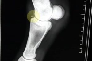 Bone chip in elbow - causes, symptoms and other risk factors Bone chip
