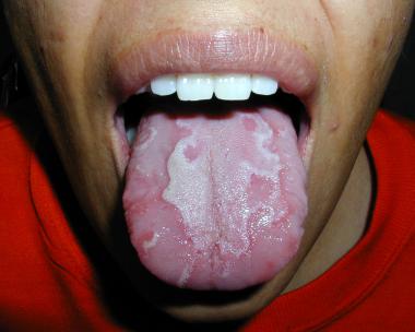 Natural cures for burning mouth syndrome