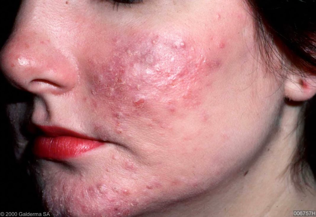 Acne rosacea symptoms, causes and other risk factors