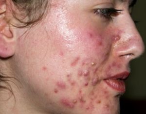 Cystic acne­