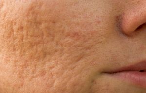 natural scar removal treatment