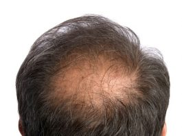 Alopecia in men
