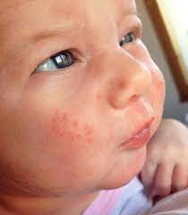 Baby Eczema Treatment
