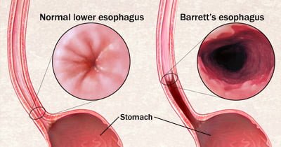 Natural cures for Barrett's Esophagus