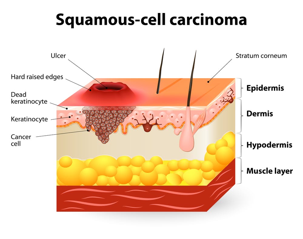 Basal cell carcinoma