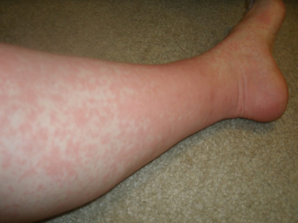 Natural Treatments For Benign Fasciculation Syndrome