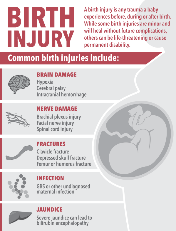 Birth injury