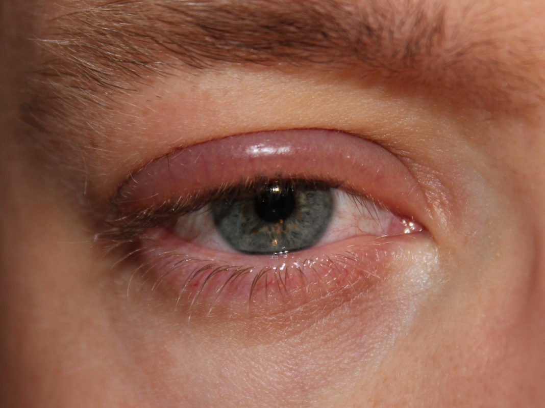Blepharitis blepharitis