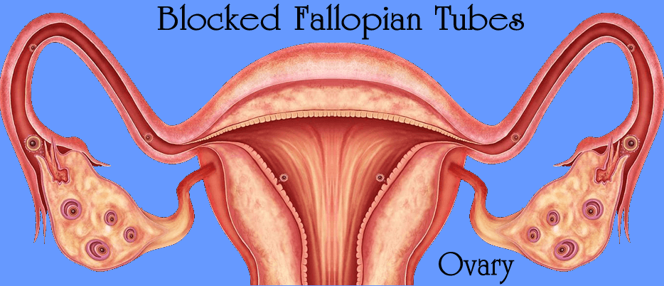 Blocked Fallopian Tubes
