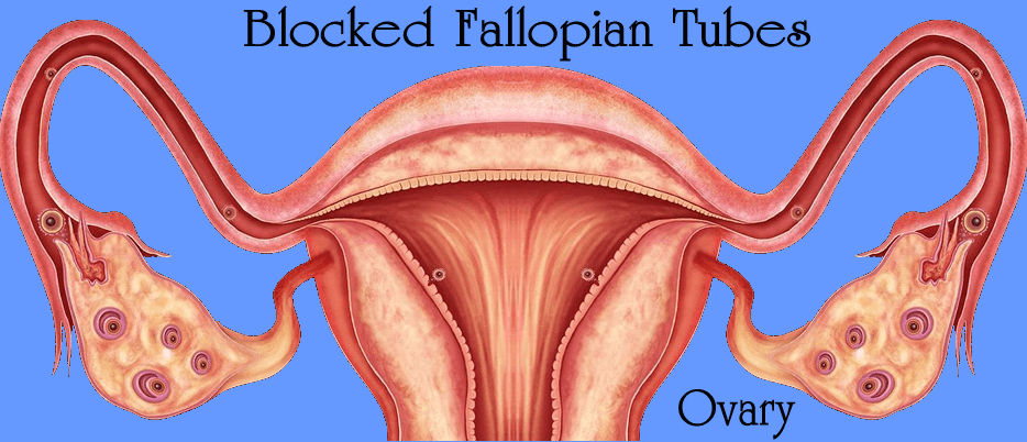 Blocked Fallopian Tubes: Some Basic Symptoms and Causes Blocked Fallopian Tubes
