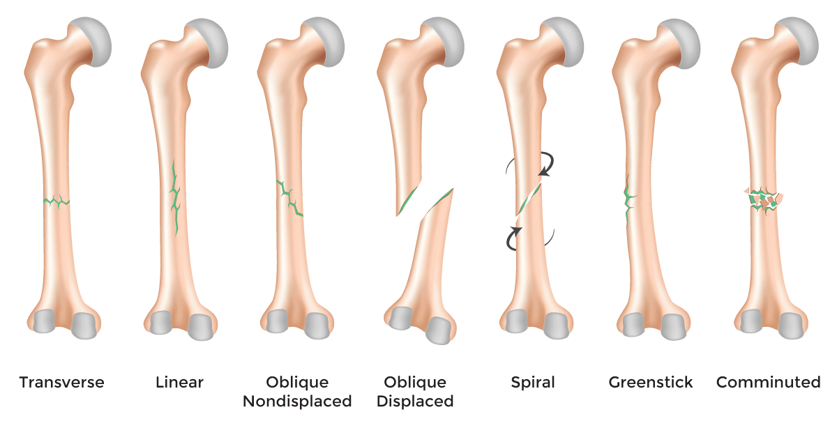 oblique bone fracture