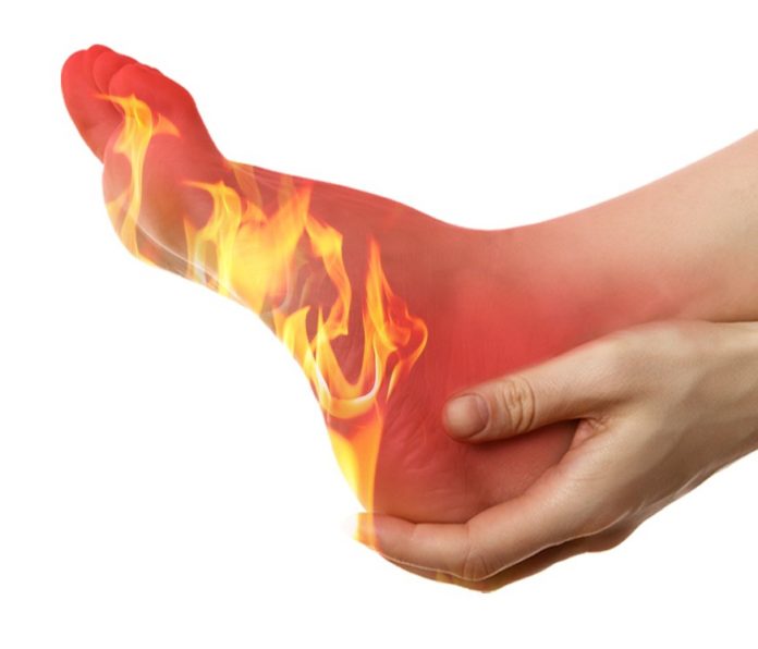 Natural cures for burning feet