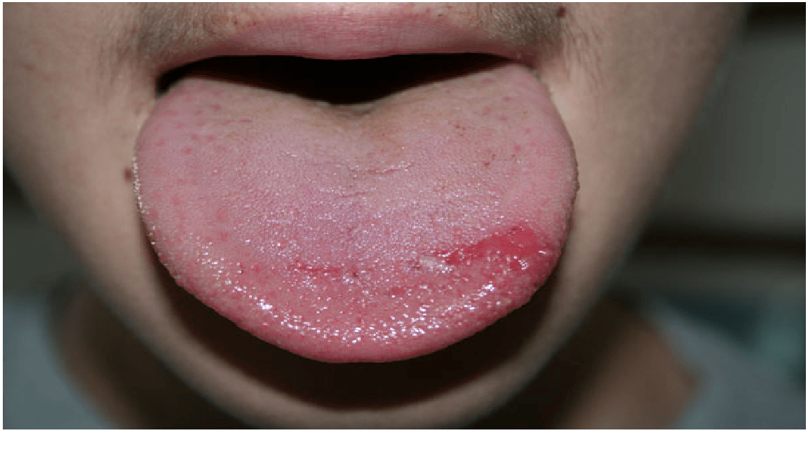 Burning Mouth Syndrome