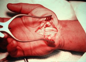 Natural carpal tunnel syndrome treatment