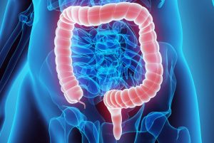 Colon cancer