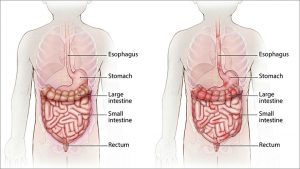 Crohn's disease