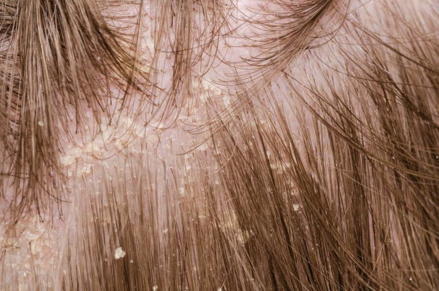 Dandruff – Symptoms, Causes and other associated risk factors Dandruff
