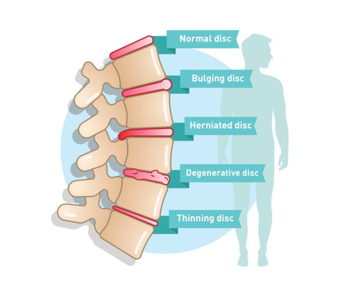 Degenerative Disc Disease - Symptoms & Causes