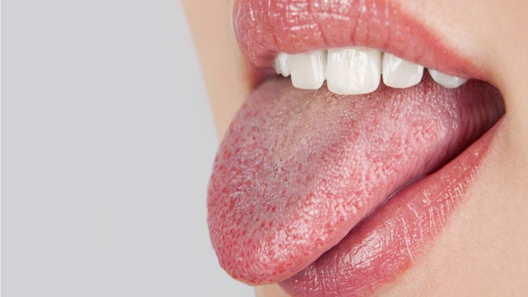 Dry mouth