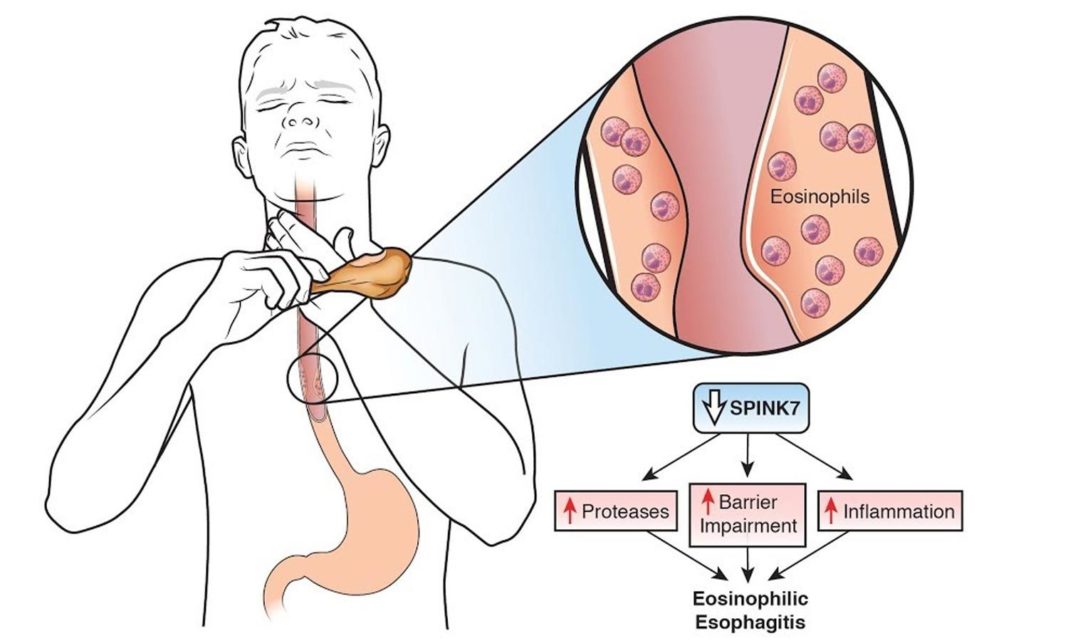 eosinophilic esophagitis