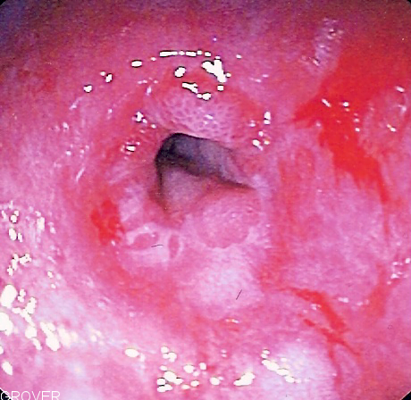 Esophageal Stricture Treatment
