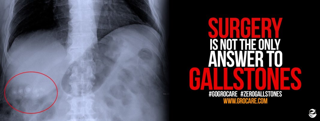 Top 8 best home remedies and treatments for gallstones