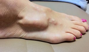 ganglion cysts causes