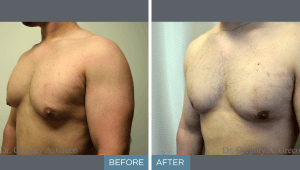 Gynecomastia