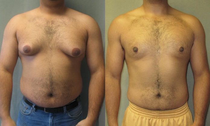Natural cures for gynecomastia