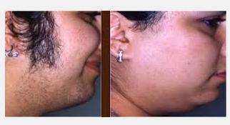 Natural cures for body hair removal