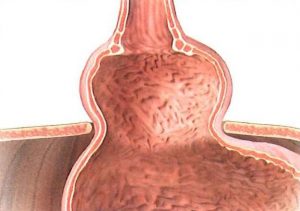 Hiatal hernia
