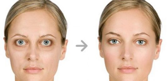 Home remedies for Graves disease1