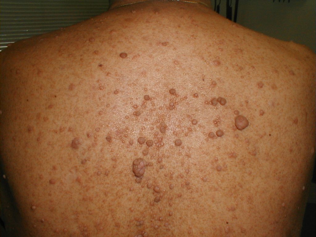 Natural treatment & home remedies for neurofibromatosis Home remedies for neurofibromatosis