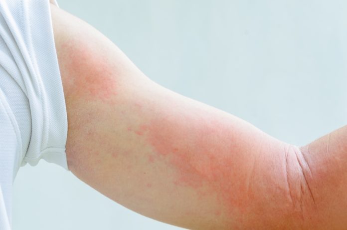 Polymorphous Light Eruption - Symptoms, Causes & Risk Factors