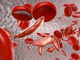 Home remedies for sickle cell disease