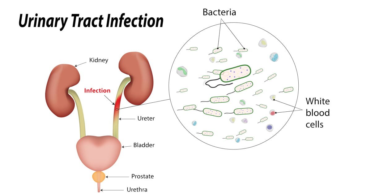 Urinary tract infection - Symptoms, causes and other risk ...