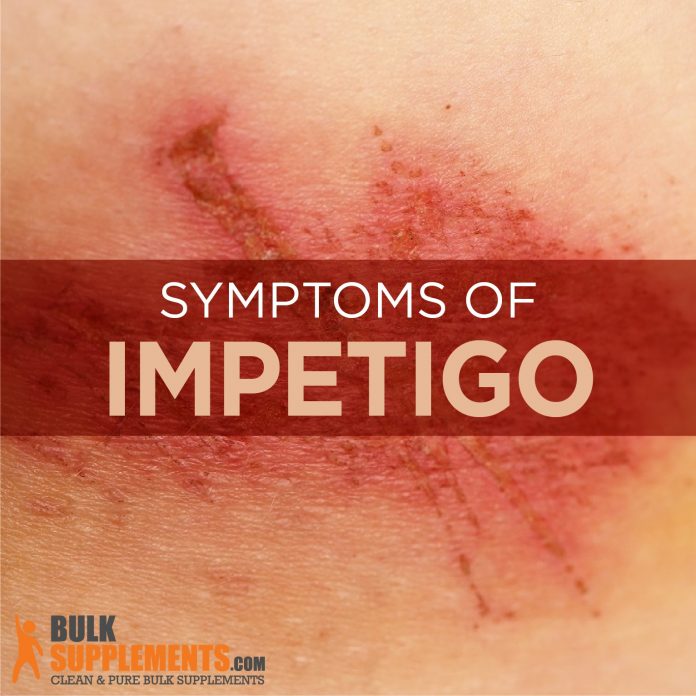 Impetigo symptoms causes
